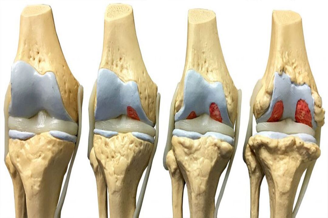 Etapas del desarrollo de la osteoartritis. 