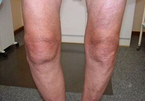 Cómo tratar la artrosis de la articulación de la rodilla
