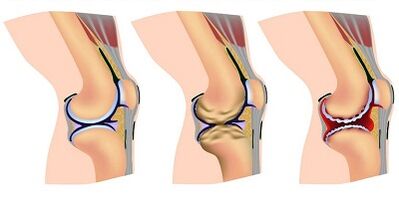 Etapas de desarrollo de la artrosis de la articulación de la rodilla