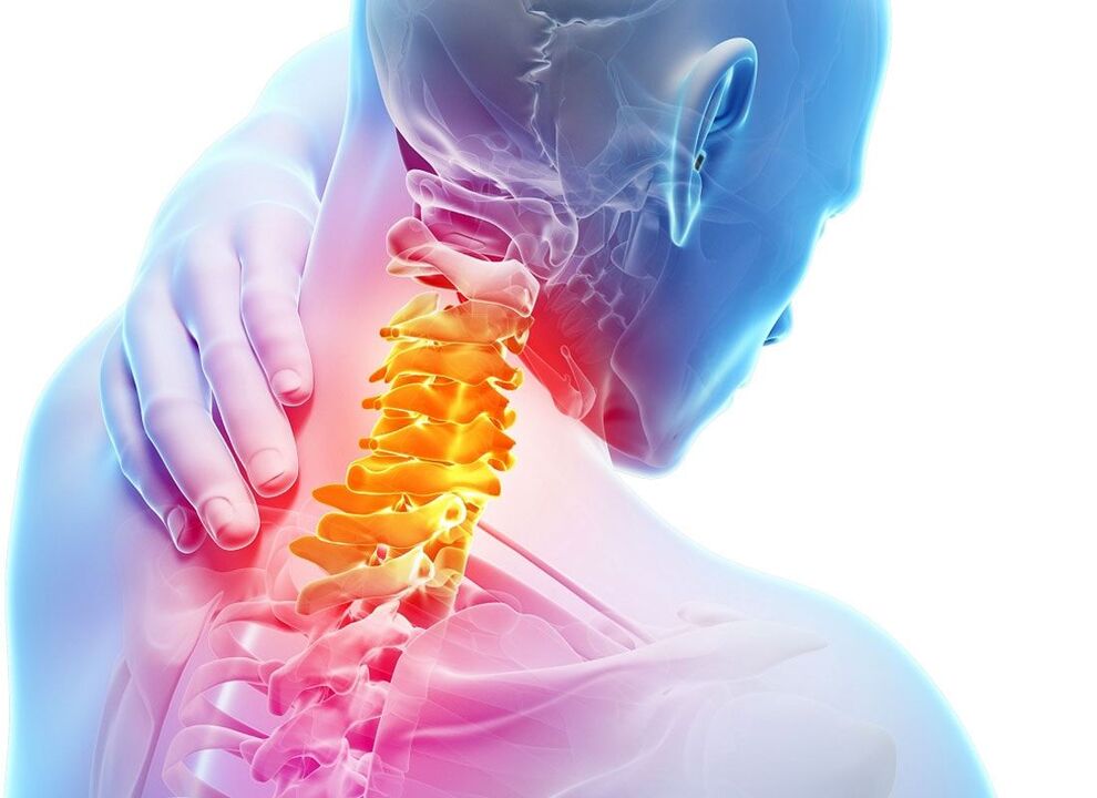 Osteocondrosis de la columna cervical. 